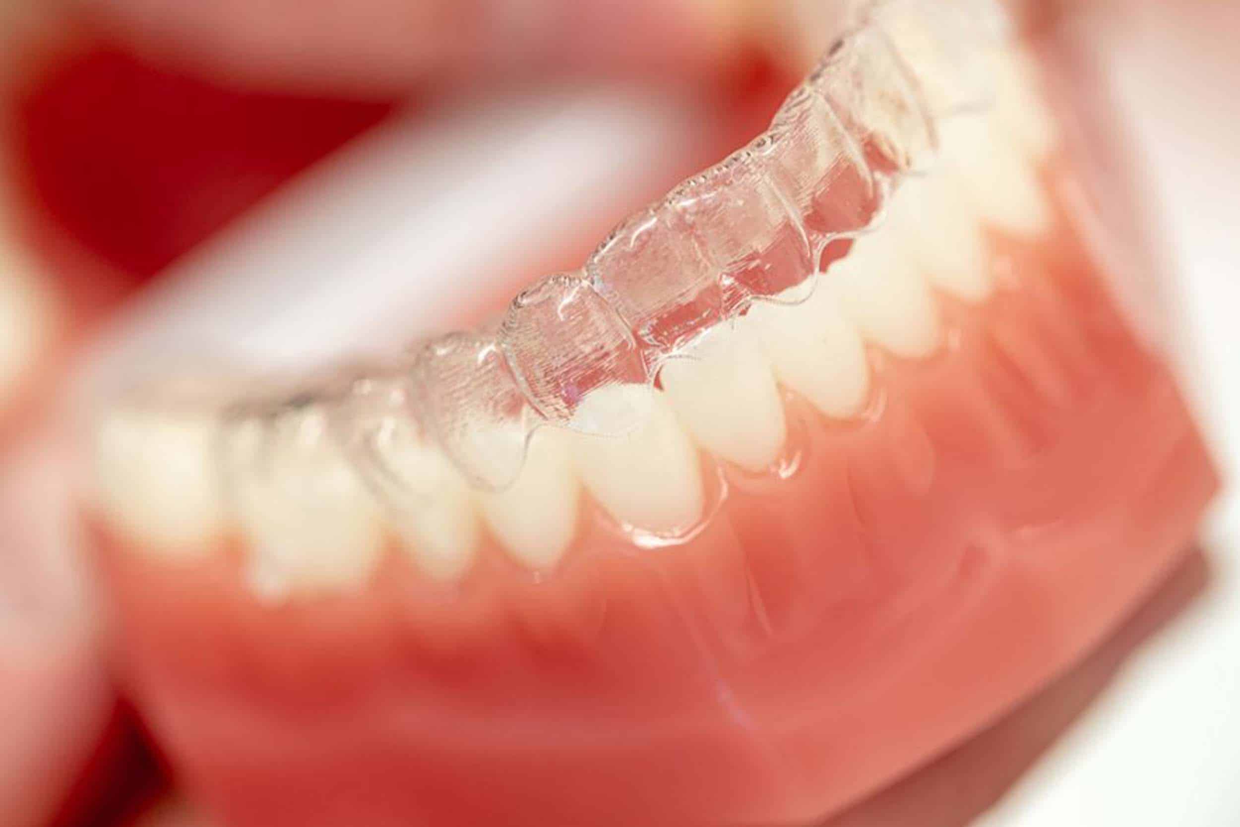 Zahnarztpraxis Hofmann Zahnarzt Solothurn Zahnarzt Subingen Zahnstellungskorrekturen Ästhetische Zahnmedizin